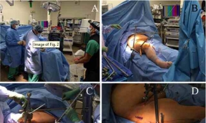 灵活的3D腹腔镜辅助复位和经皮固定治疗髋臼骨折-新手术方案的介绍
