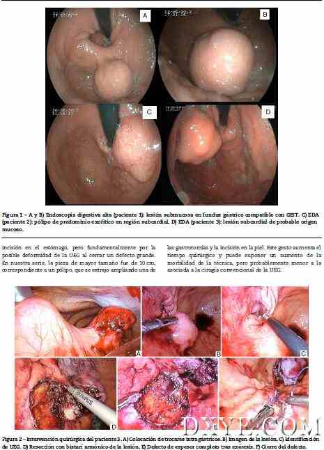 胃内腹腔镜手术：胃癌病灶不经胃镜切除的选项