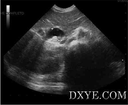 Fig. 1. Abdominal ultrasound of choledochal cyst.