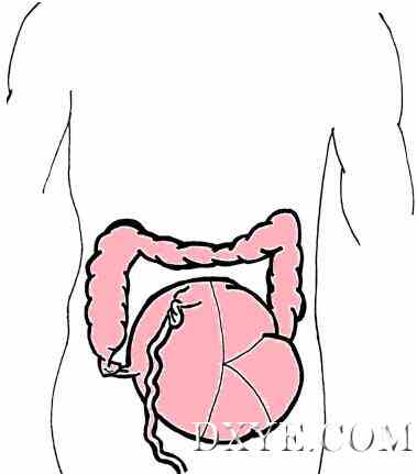 选择性腹腔镜结肠切除右盲肠扭转--病例报告及文献复习