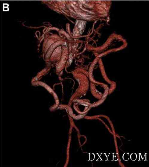 侧支血流相关肠系膜上动脉瘤慢性近肾腹主动脉闭塞B
