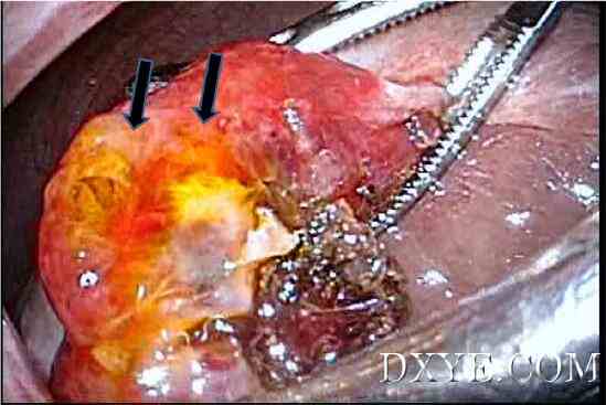 倒钩缝合术在腹腔镜胆囊切除术中胆管损伤修复中的应用——附2例报告