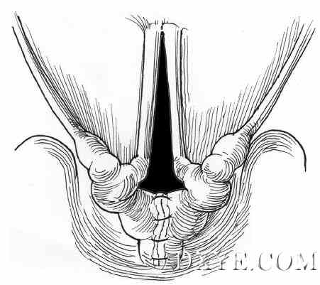 喉裂的内窥镜修复术