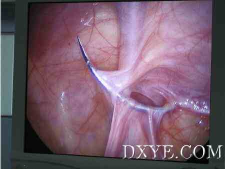 单孔腹腔镜经腹膜外封闭在VAS输精管和睾丸灌注的影响方向和体积-从一个单一的中心的经验