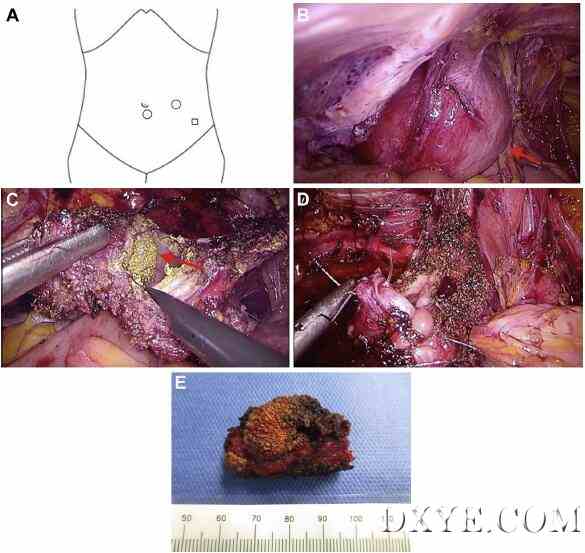 腹腔镜部分性膀胱切除术与网状疝修复后网状结构移入膀胱