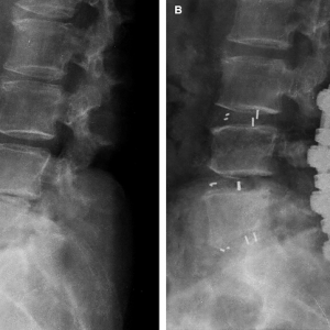 通用固定夹+椎间融合新技术治疗脊柱退变