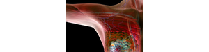 腋窝淋巴结超声有助于乳腺癌患者获得个体化治疗方案