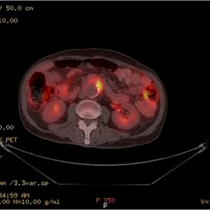 PET-CT：腹主动脉炎可靠的诊断方法