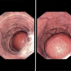 逆行性胃食管套叠（RGEI） 所致反复吞咽困难 1 例