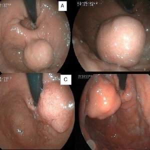 胃内腹腔镜手术：胃癌病灶不经胃镜切除的选项