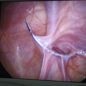 单孔腹腔镜经腹膜外封闭在VAS输精管和睾丸灌注的影响方向和体积-从一个单一的中心的经 ...