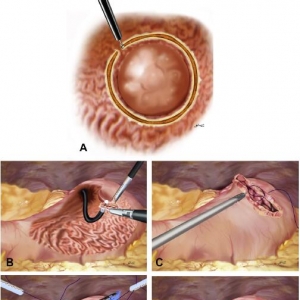 腹腔镜与内镜联合手术治疗胃黏膜下肿瘤的可行性（附视频）