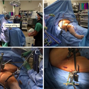 灵活的3D腹腔镜辅助复位和经皮固定治疗髋臼骨折-新手术方案的介绍
