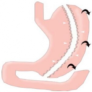 案例：MDCT作为诊断选择的方式在腹腔镜胃袖状切除术后并发症分析