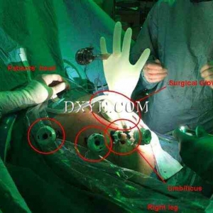 外科手套口在腹腔镜全胃切除术中的应用