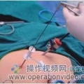 腹腔镜手术切口