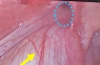 输尿管腹股沟疝：腹腔镜手术治疗腹股沟疝的附加优势——病例报告