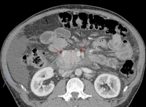 坏死性胰腺炎患者脐疝修补术中意外出现乳糜性腹水一例报告