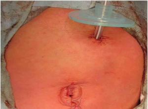 新生儿小网膜疝伴肠旋转不良和先天性十二指肠狭窄