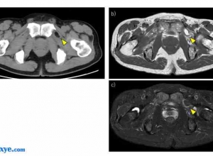 单切口腹腔镜完全腹膜外（SILS-TEP）修补术治疗中年男性患者因脂肪栓塞引起的闭孔疝伴