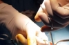 包皮环切术（背缝技术）