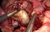 腹腔镜卵巢扭转（带画外音）- 保留卵巢手术