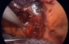 腹腔镜Morgagni疝修补术（生物网片）