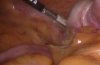腹腔镜盲肠切除术治疗阑尾肿瘤