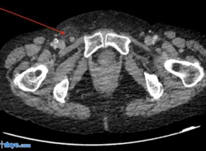 一例伴有阑尾炎的De Garengeot疝