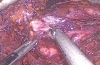 Nissen胃底折叠术后行腹腔镜Roux-en-Y胃旁路术