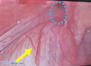 输尿管腹股沟疝：腹腔镜手术治疗腹股沟疝的附加优势——病例报告