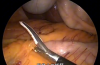 腹腔镜辅助下切除巨大阑尾黏液性肿瘤