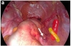 开腹和腹腔镜双侧子宫颈韧带置换术的比较：一年随访研究