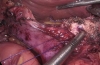 腹腔镜胰管空肠吻合支架