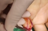 指尖缺损的VY推进皮瓣