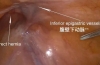 TAPP腹股沟疝修补术-腹腔镜分步解剖