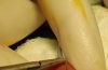 MAGPI 尿道下裂修复