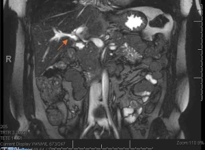 胆囊发育不全与功能影像假阴性：病例报告