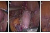 腹腔镜子宫切除术中阴道和腹部子宫操作的比较分析：Boztosun技术