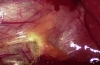 腹腔镜胆囊切除术