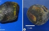 单纯肠切开取石术治疗复发性胆石性肠梗阻一例