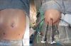 机器人辅助腹腔镜手术矫正婴儿先天性高胰岛素血症