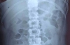 患有Amyand型梗阻性腹股沟疝的患者的治疗：一例罕见病例报告