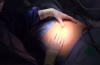 腹腔镜阑尾切除术和开放式脐疝修补术
