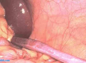腹腔镜检查诊断交通性鞘膜积液患儿连续性脾腺融合