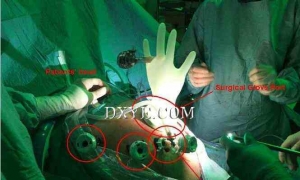 外科手套口在腹腔镜全胃切除术中的应用