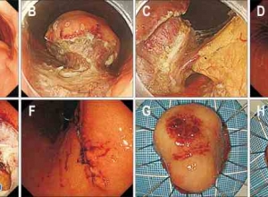 胃上皮下肿瘤内镜治疗进展