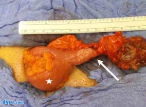 Littre疝气的手术治疗：Meckel憩室的罕见表现