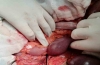腹腔镜胆囊切除术后小肠扭转：病例报告及文献复习