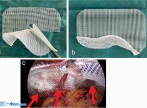 作者是否需要重新思考内镜下腹股沟疝修补术中的裂隙网片技术？——一项配对分析